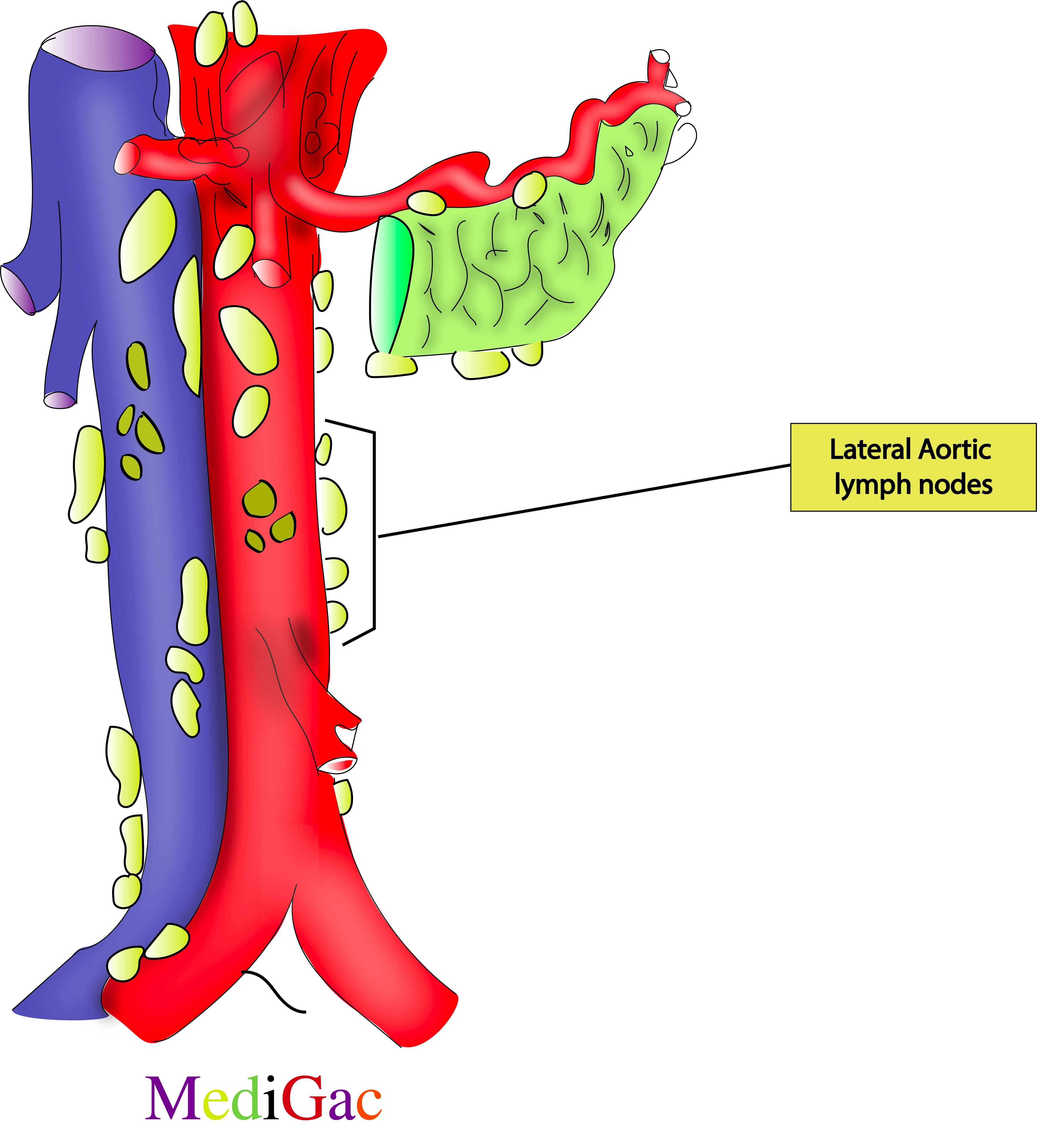 Lateral aortic lymph nodes